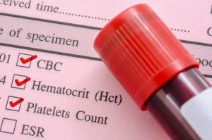 Complete Blood Count (CBC) test for Dengue patient